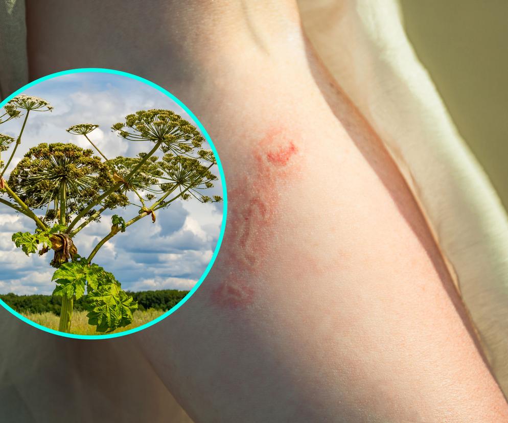 Uwaga na toksyczną roślinę. Bolało tak bardzo, że zemdlałem