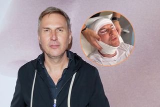 Krzysztof Gojdź zafundował sobie lifting twarzy. Zabieg jest bezbolesny