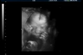 27 tydzień ciąży USG dziecka