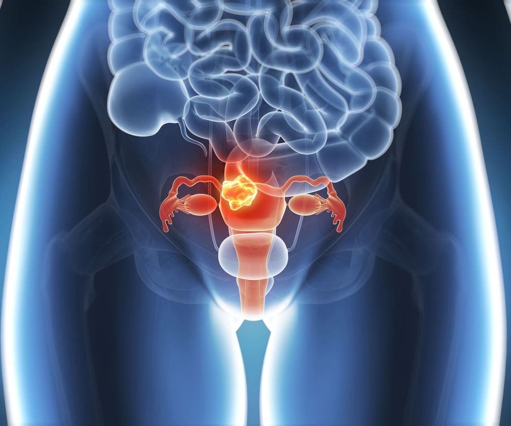 Embolizacja: leczenie mięśniaków macicy