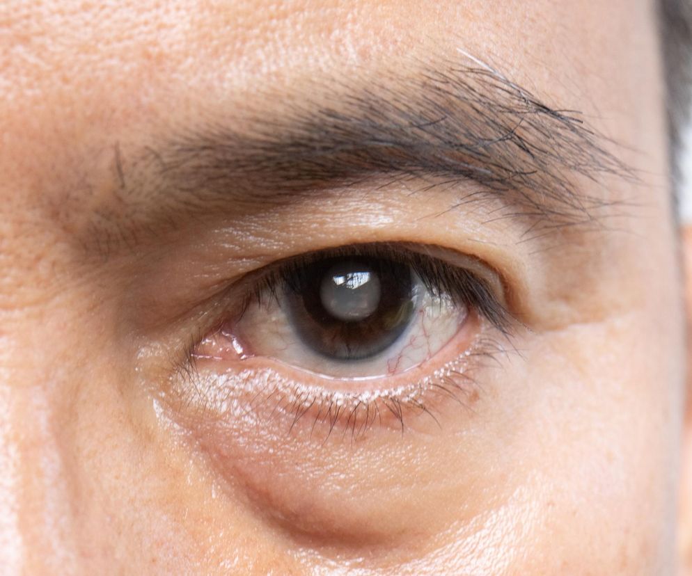 Jaskra może być spowolniona. Niektóre witaminy przynoszą nadzieję pacjentom