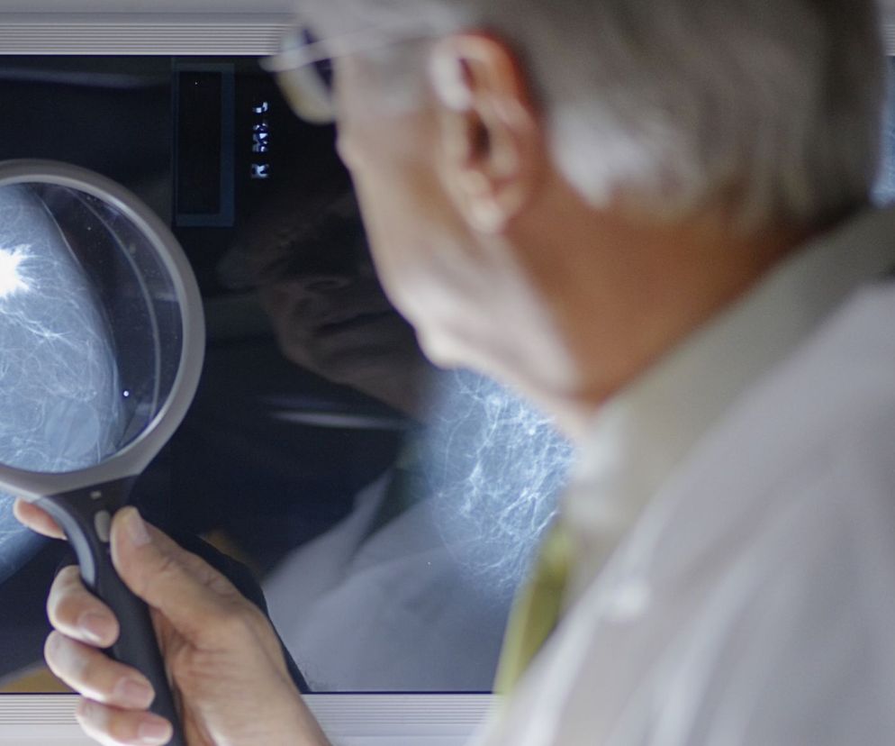 Guzki piersi to zwykle łagodne zmiany, ale nie ich również nie należy lekceważyć.