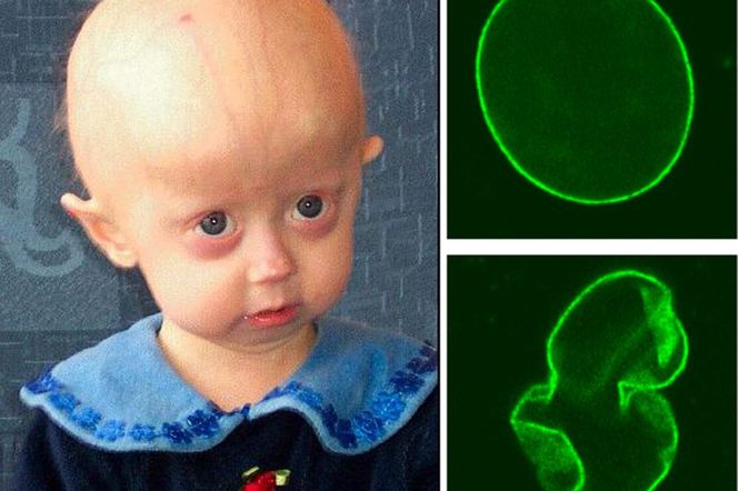 Progeria