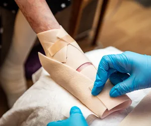 Epidermolysis Bullosa - pęcherzowe oddzielanie się naskórka