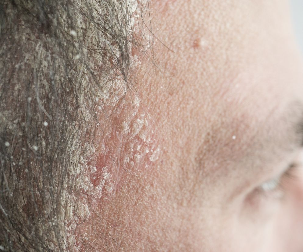 zbliżenie na łuszczycę skóry głowy u mężczyzny