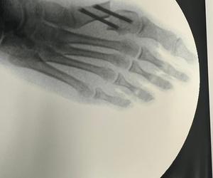 Chorzów. Innowacyjny zabieg u dziecka przeprowadzony po raz pierwszy na Śląsku