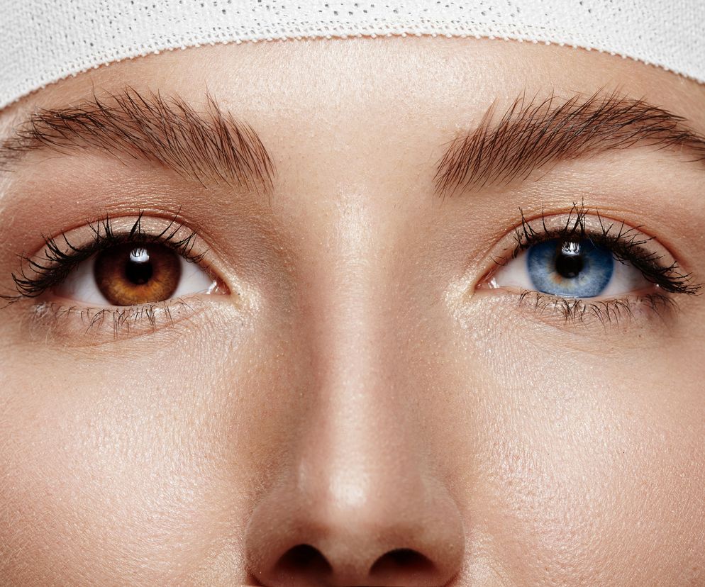 Heterochromia występuje zarówno u ludzi, jak i u zwierząt