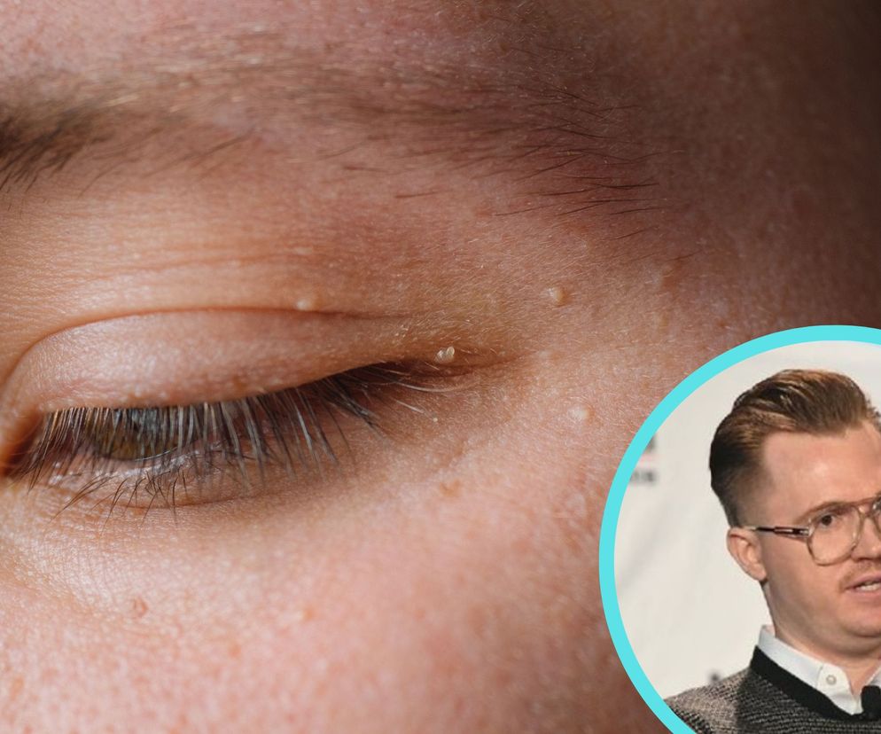 Dermatolog z Polski wykrył najmniejszego raka świata. Krył się w plamce na policzku