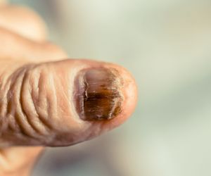 Czerniak paznokcia – przyczyny, objawy, diagnostyka, leczenie