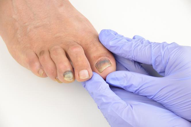Zasinienie pod paznokciami też może być objawem grzybicy paznokci