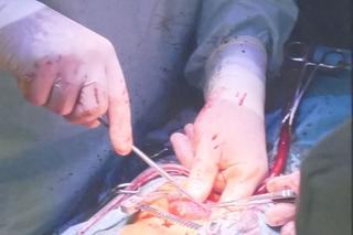 Drut przebił serce 5-letniego Przemka spod Opoczna