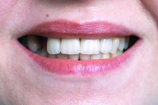 Będzie lek na odrastanie utraconych zębów. Naukowcy wskazali datę