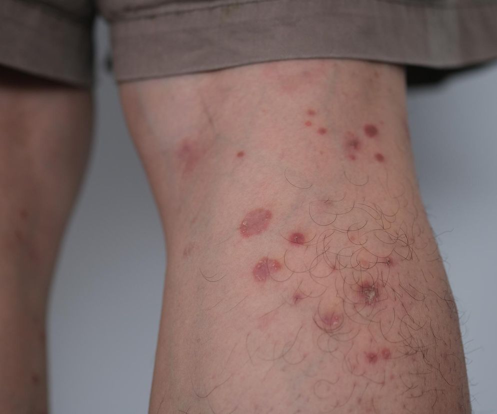 Objaw u 42-latka wydawał się niegroźny. Teraz zostało mu kilka miesięcy życia