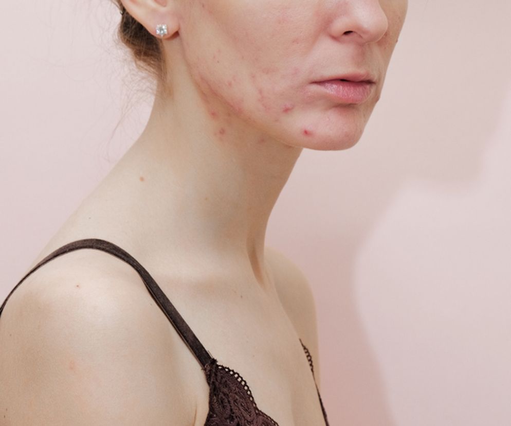 Podrażniona skóra twarzy