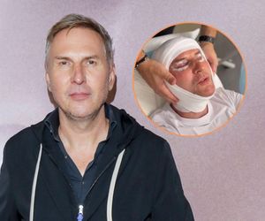 Krzysztof Gojdź zafundował sobie lifting twarzy. Zabieg jest bezbolesny