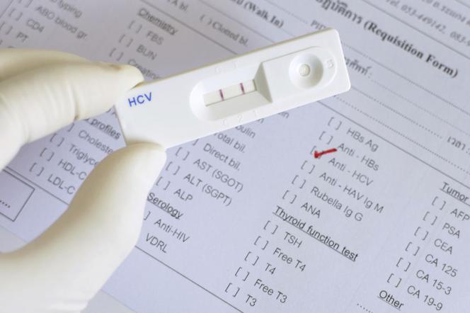 Test na HCV: dlaczego warto go zrobić?