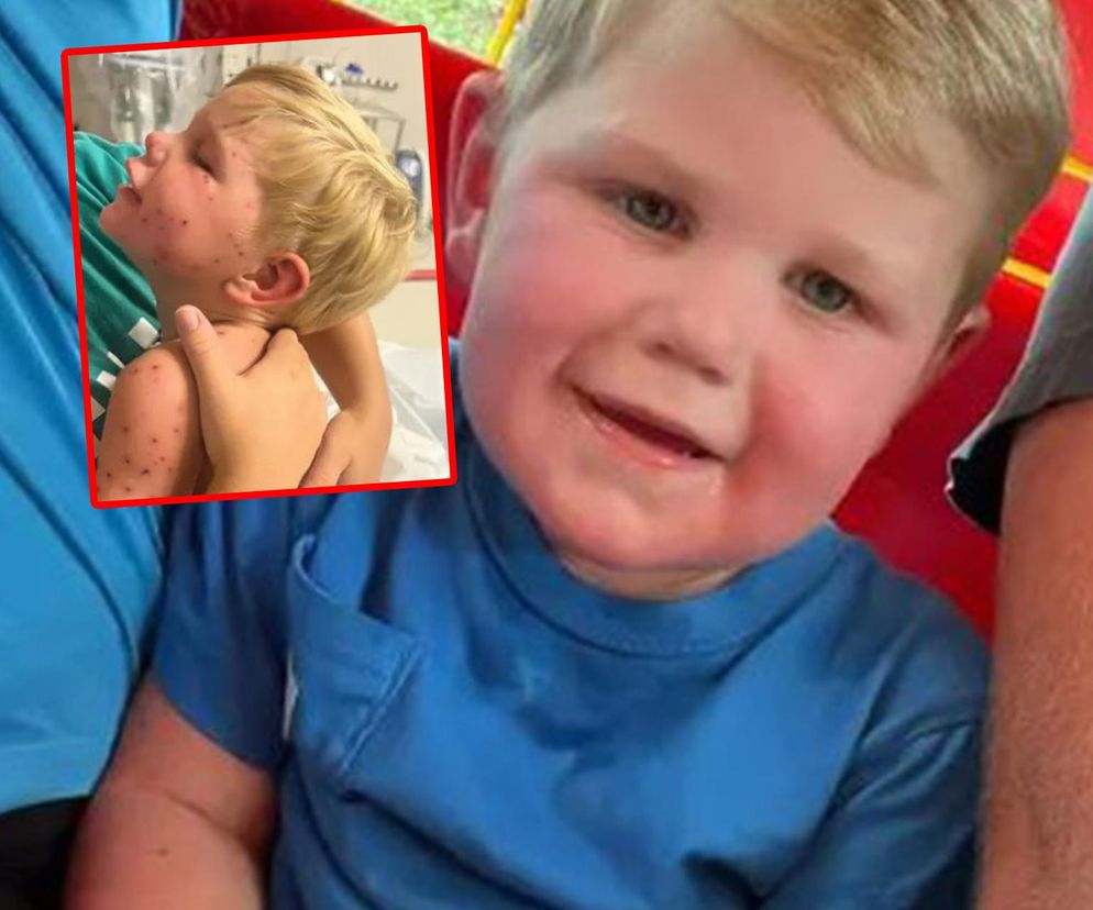 2-latek użądlony 150 razy! Osy zaatakowały, gdy wjechał zabawką w ich gniazdo. Walczy o życie!