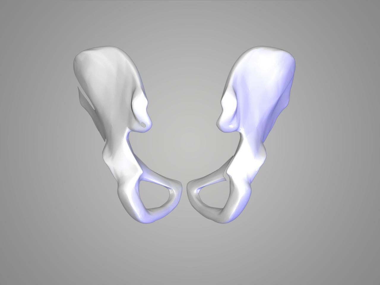 Choroba Perthesa (Legga-Calvego-Perthesa) - jałowa martwica głowy kości udowej