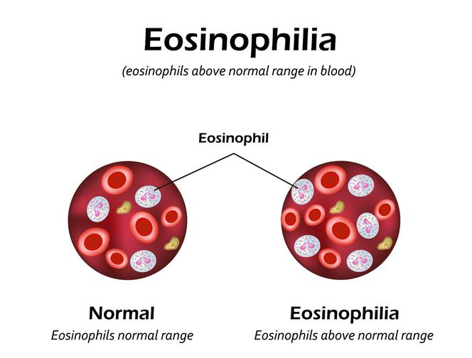 Eozynofilia: rodzaje i przyczyny