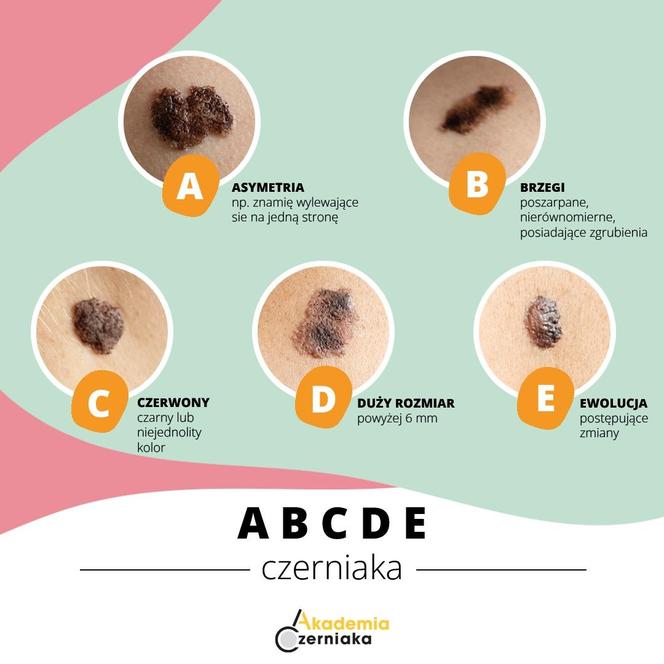 ABCDE czerniaka 2024