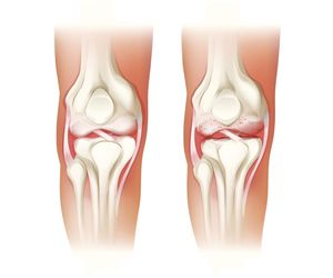 Zapalenie kaletki maziowej - przyczyny i objawy. Leczenie zapalenia kaletki maziowej