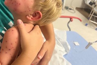 Dramat 2-latka. Wjechał w gniazdo os i został użądlony 150 razy. Teraz walczy o życie