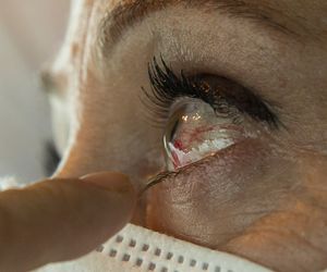 Pęknięte naczynko w oku: czego to objaw? Przyczyny popękanych naczynek w oku