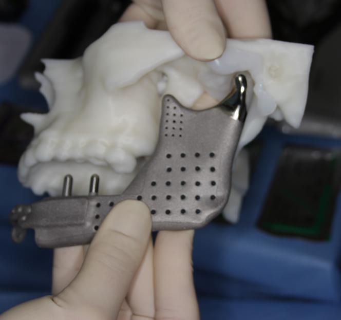 Wydrukowali mu nowe kości twarzy