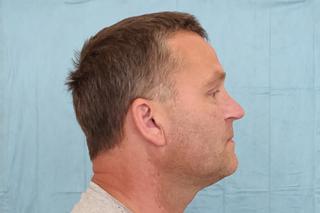 Wydrukowali mu nowe kości twarzy