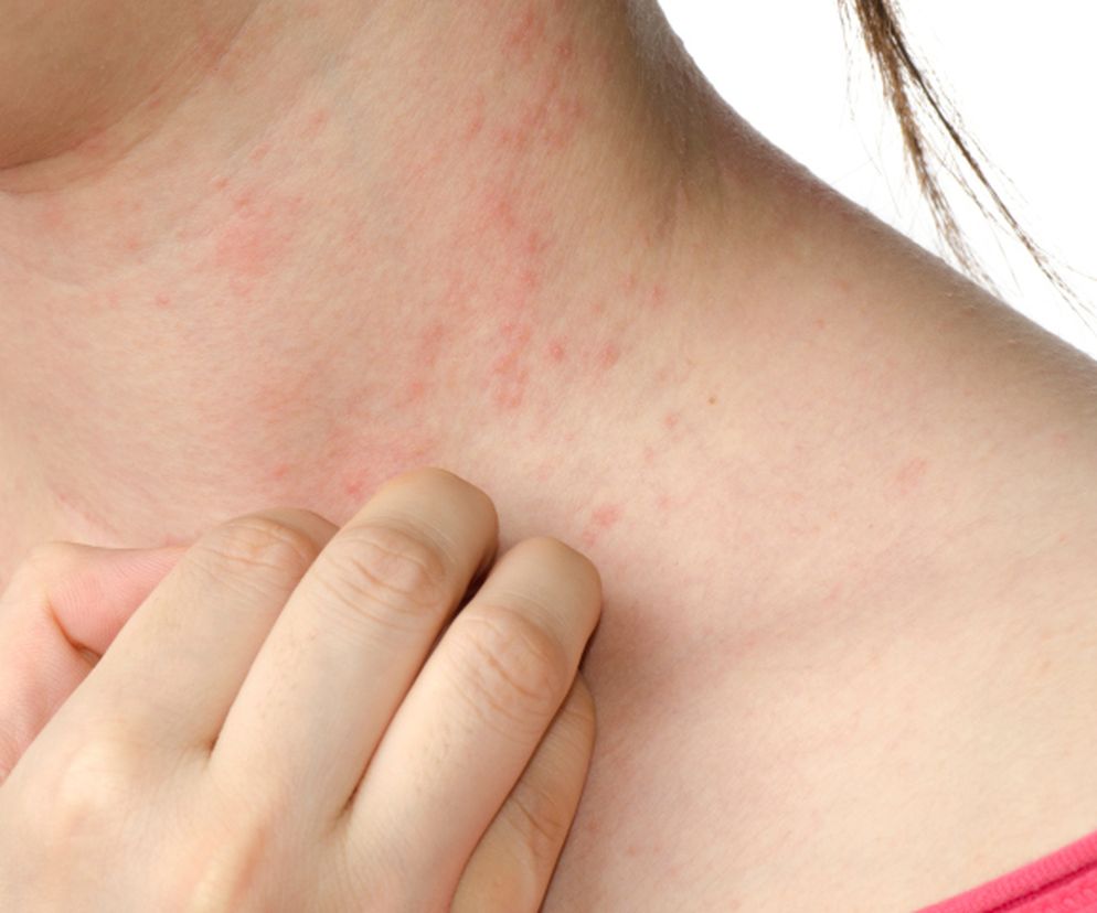 Alergia skórna