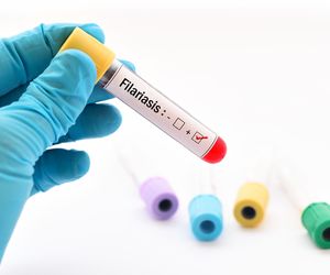 Filariozy: przyczyny, rodzaje, objawy, leczenie