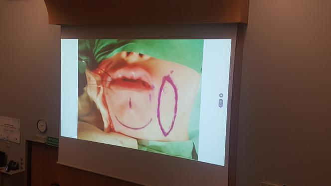 Gliwiccy lekarze dokonali kolejnego na światową skalę przeszczepu narządów szyi