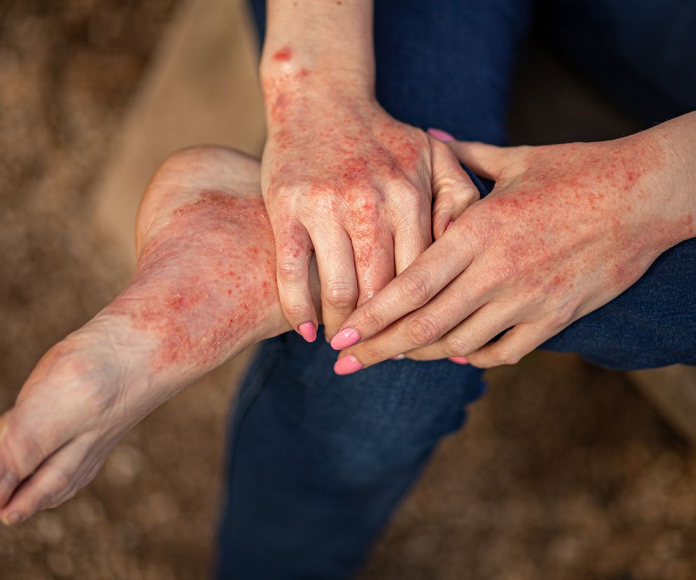 Nietypowe powikłanie COVID. Pojawia się na skórze