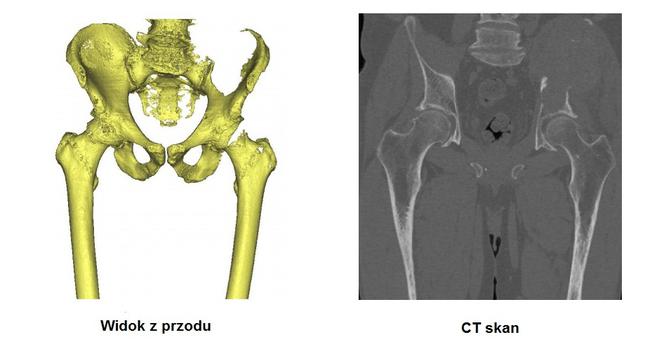 Tak wyglądała miednica pacjenta przed operacją