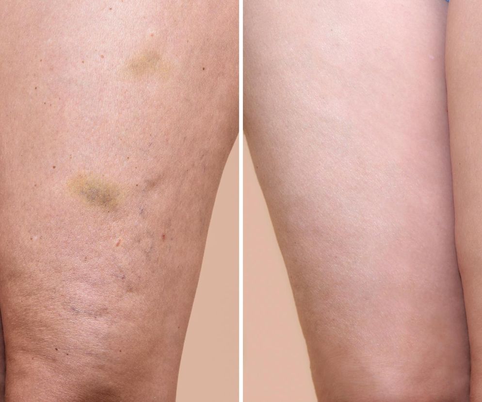 Lepsze niż drenaż limfatyczny. Szukaj w kosmetykach tej rośliny, a pozbędziesz się cellulitu