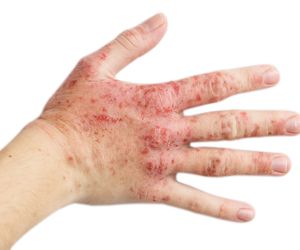 Ciężki przewlekły wyprysk rąk - przyczyny, objawy i leczenie