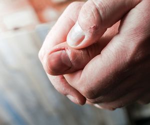 Zanokcica nie zawsze jest niegroźną zmianą. Poznaj przyczyny, objawy, leczenie