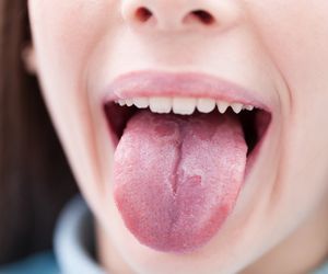 Zmiana koloru języka jest objawem choroby. Jakie schorzenie zdradza?