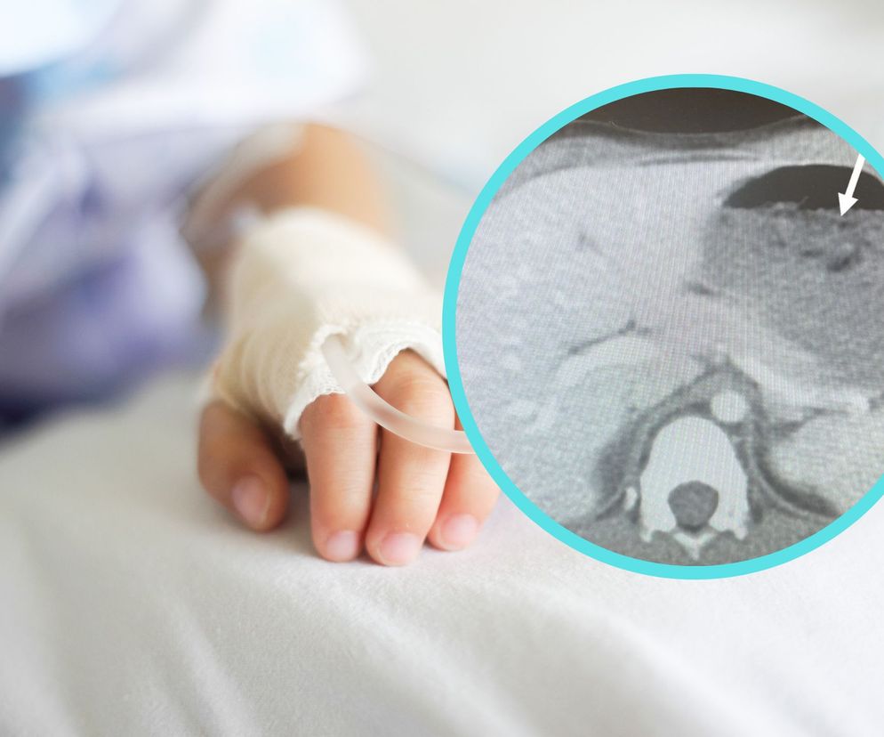 5-latek trafił na SOR z ostrym bólem brzucha. To lekarze znaleźli w jego żołądku