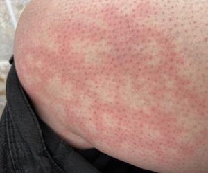 Takie zmiany skórne to znak, że krążenie szwankuje. Sprawdź, czy jesteś w grupie ryzyka