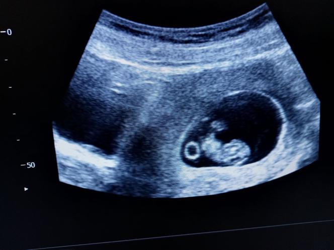 8 tydzień ciąży - USG