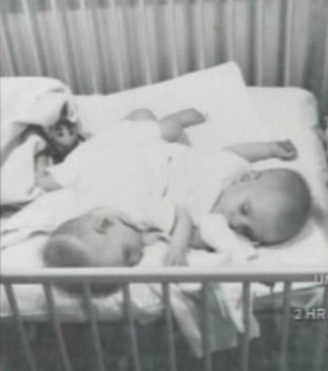 Przeżyli zrośnięci 68 lat. Nie żyją najdłużej żyjące bliźnięta syjamskie. Ronnie i Donnie Galyon
