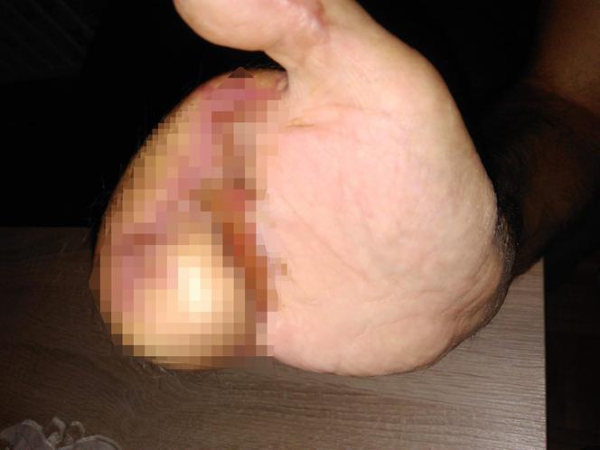 Maszyna zmiażdżyła palce