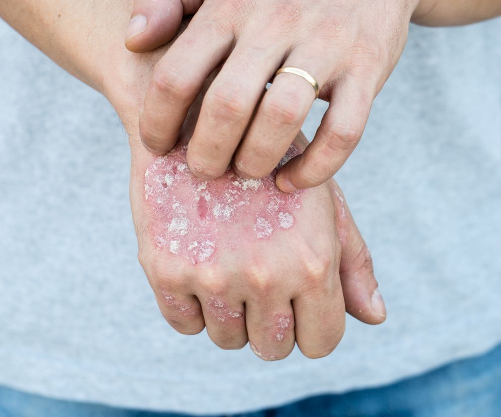 Zmiany na skórze mogą mieć związek z chorobami jelit.