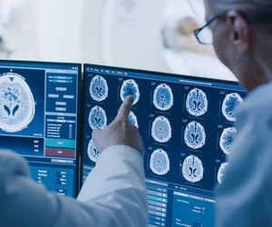 Nowotwory złośliwe mózgu – rodzaje, objawy i leczenie