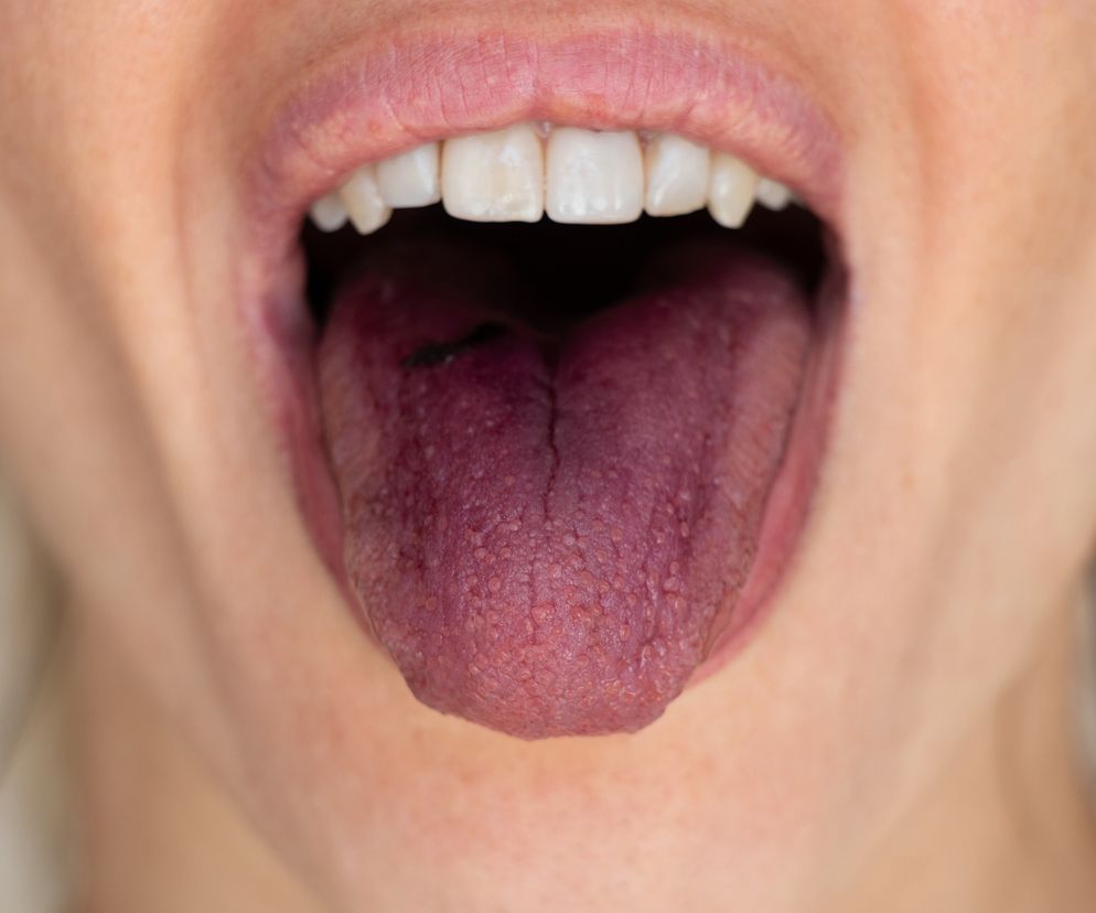 Drastycznie przybywa chorych na szkarlatynę. Zwróć uwagę na swój język