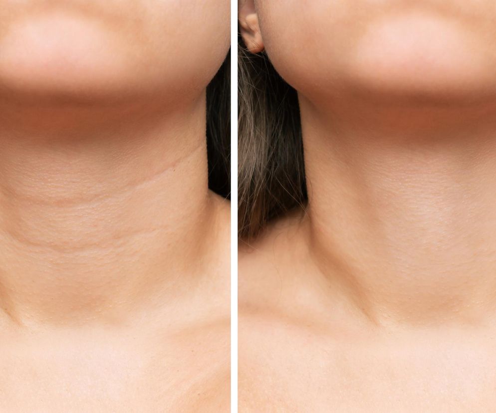 Działa jak profesjonalny zabieg, a zrobisz go za darmo. Najlepszy sposób na zmarszczki na szyi