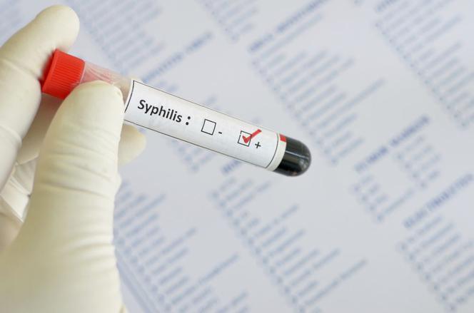Objawy i leczenie syfilisu kiły