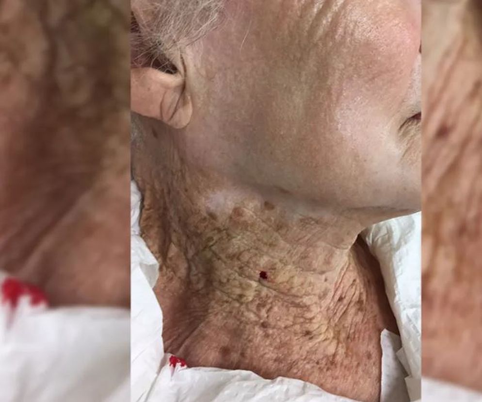 To zdjęcie pokazuje, jak skuteczne są kremy z filtrem UV. Naprawdę robi wrażenie