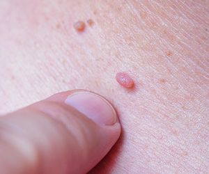 Strupki, plamki, krosty. Dermatolożka ostrzega przed mniej znanym rakiem skóry